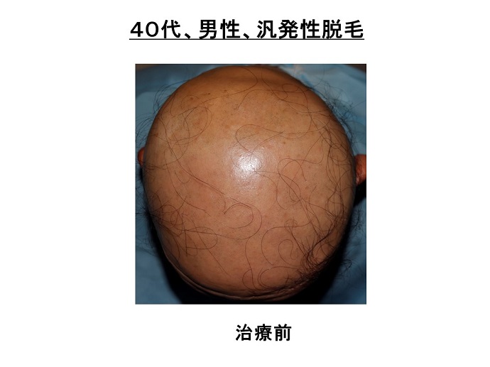 円形脱毛症　名医